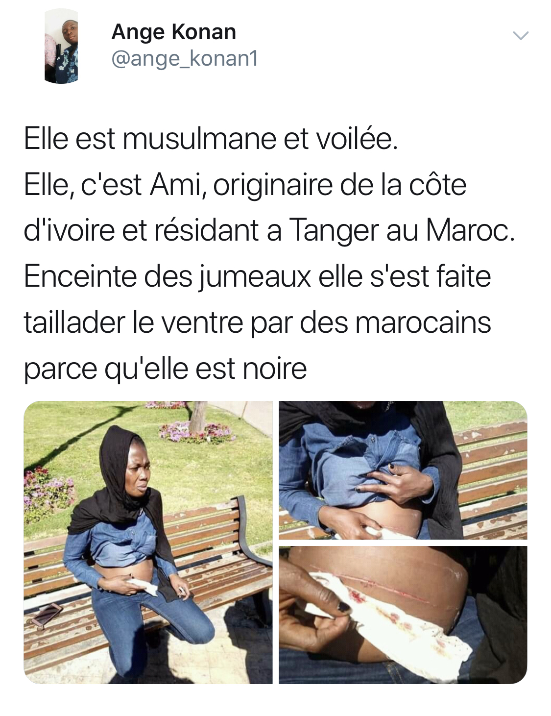 Racisme au Maroc : cette Ivoirienne enceinte se fait taillader le ventre par des Marocains «parce qu’elle est noire»