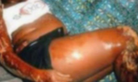 Nioro : une femme enceinte ébouillantée par sa coépouse à Touba Saloum