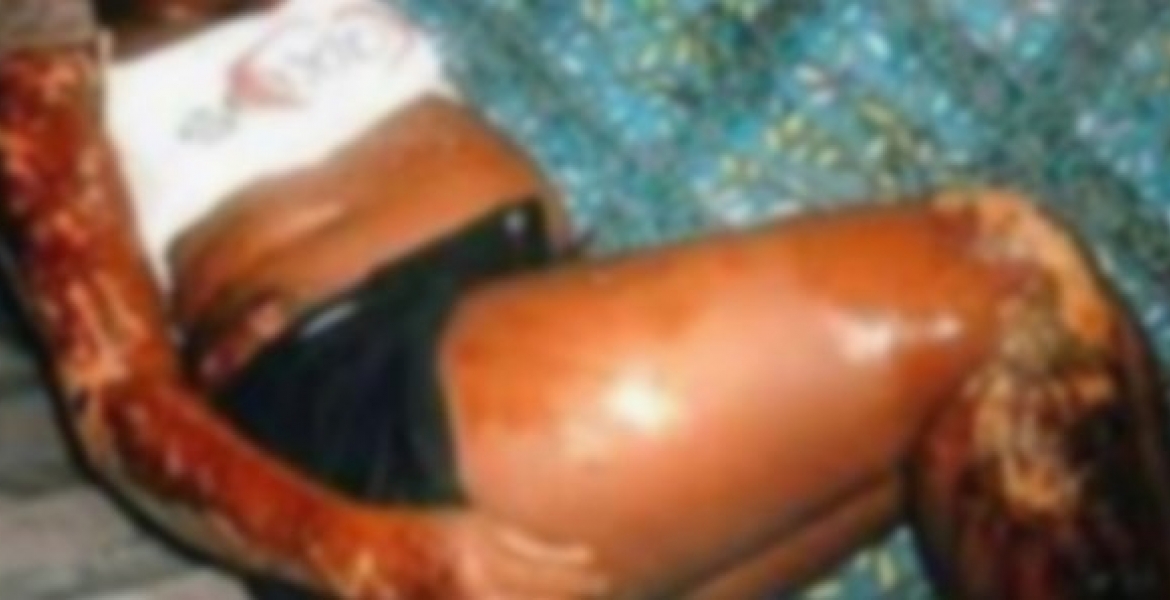 Nioro : une femme enceinte ébouillantée par sa coépouse à Touba Saloum